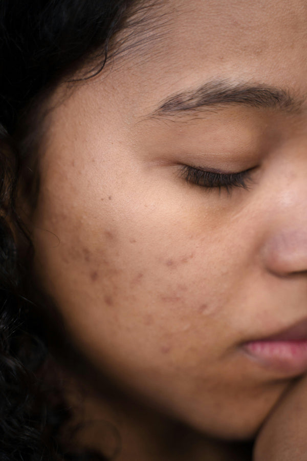 Acne & Oily Skin
